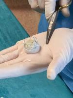 Zastawkę aortalną wszczepiono kobiecie metodą przezskórną. 85-latka czuje się dobrze