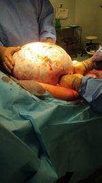 Pacjentka myślała, że przytyła. Lekarze usunęli blisko 30 kilogramowego guza z brzucha