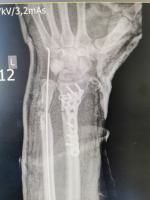 W szpitalu w Kędzierzynie-Koźlu przyszyto prawie urwaną rękę