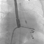 "Zmniejszyli serce" by wykonać zabieg. Niezwykła operacja chirurgów USK w Opolu