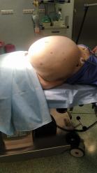 Pacjentka myślała, że przytyła. Lekarze usunęli blisko 30 kilogramowego guza z brzucha