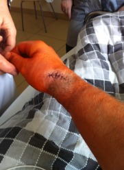 Bartłomiej Bonk zdobywał medale z kontuzją nadgarstka