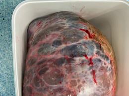Pacjentka myślała, że przytyła. Lekarze usunęli blisko 30 kilogramowego guza z brzucha