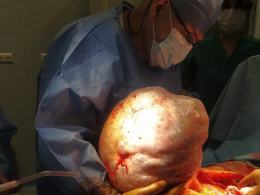 Pacjentka myślała, że przytyła. Lekarze usunęli blisko 30 kilogramowego guza z brzucha