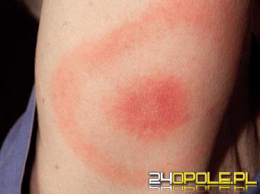 Uwaga na kleszcze, mogą przenosić bardzo groźne choroby