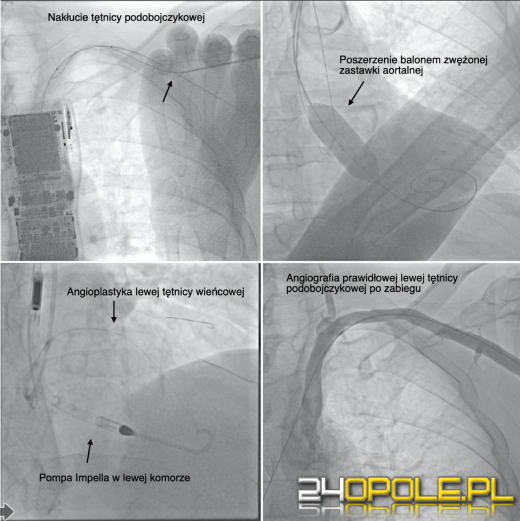 Zespół lekarzy oddziału kardiologii i anestezjologii USK przeprowadził historyczny zabieg