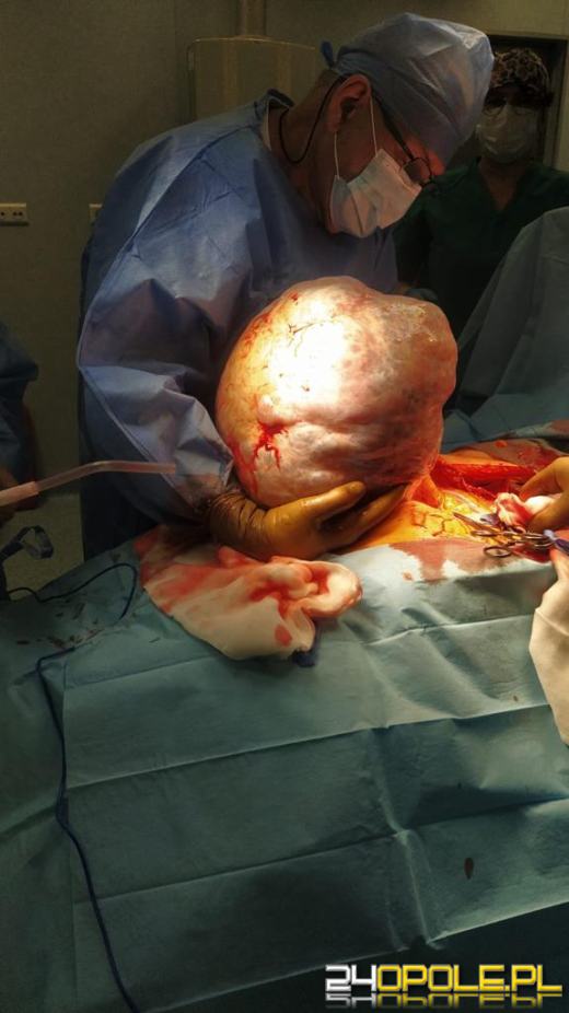 Pacjentka myślała, że przytyła. Lekarze usunęli blisko 30 kilogramowego guza z brzucha