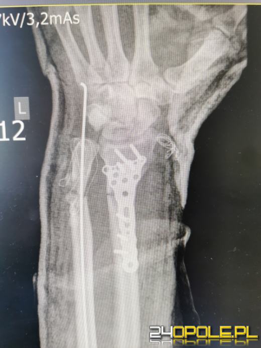 W szpitalu w Kędzierzynie-Koźlu przyszyto prawie urwaną rękę