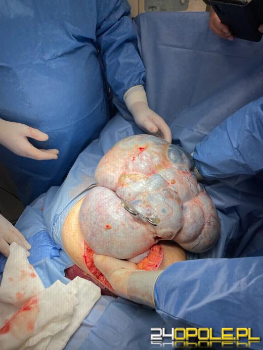 Guz jajnika ważył 11 kilogramów. Lekarzom udało się go usunąć