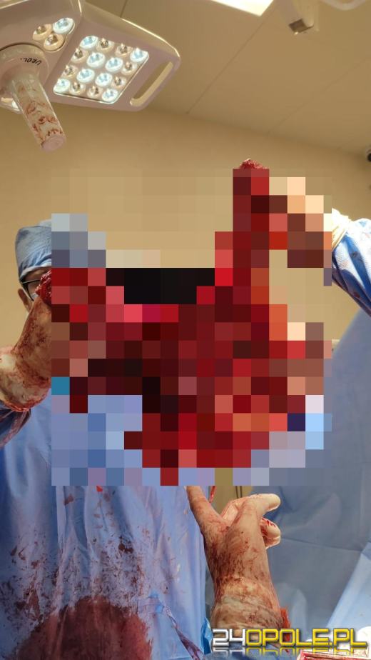 Gigantyczny guz nerki wycięty na oddziale w Kędzierzynie-Koźlu