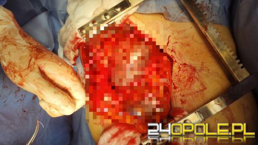 Gigantyczny guz nerki wycięty na oddziale w Kędzierzynie-Koźlu