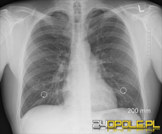 Sztuczna inteligencja zadba o nasze płuca