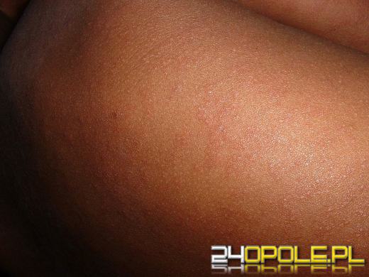 Powraca dawno zapomniana choroba zakaźna 