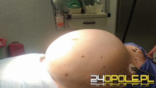 Pacjentka myślała, że przytyła. Lekarze usunęli blisko 30 kilogramowego guza z brzucha
